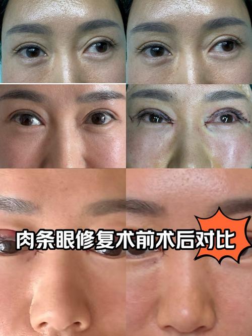 苏州双眼皮可选美贝尔_双眼皮修复手术_双眼皮修复后疤痕问题